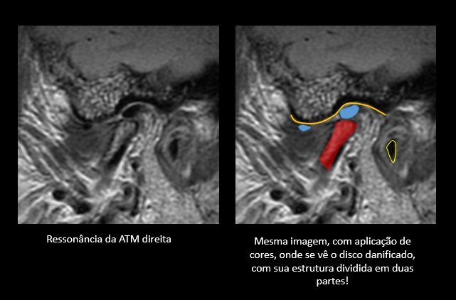 Quando a cirurgia da ATM falha - Portal Patologia da ATM