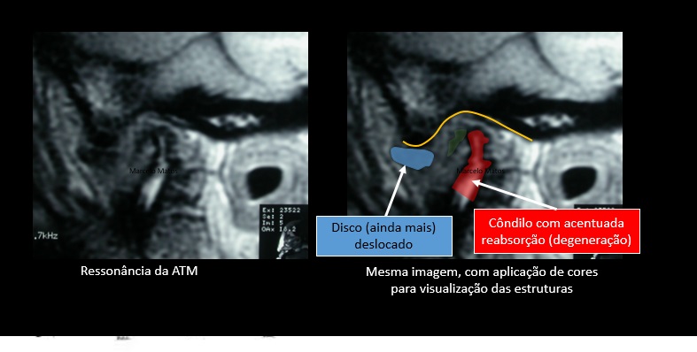 Quando a cirurgia da ATM falha - Portal Patologia da ATM