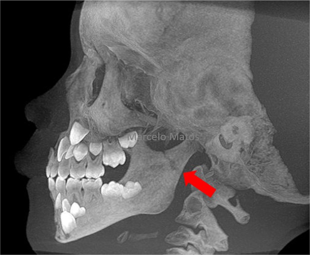 Odontoclínica Novo Hamburgo - A articulação temporomandibular (ATM) funciona  como uma dobradiça que liga o maxilar ao crânio. Esta disfunção pode causar  dor e desconforto. Dores no maxilar, dificuldade de mastigar e